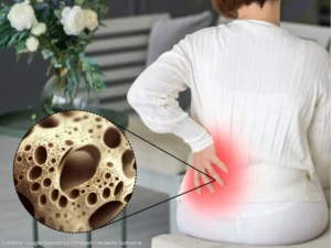 Osteoporose: 5 hábitos diários que estão enfraquecendo seus ossos